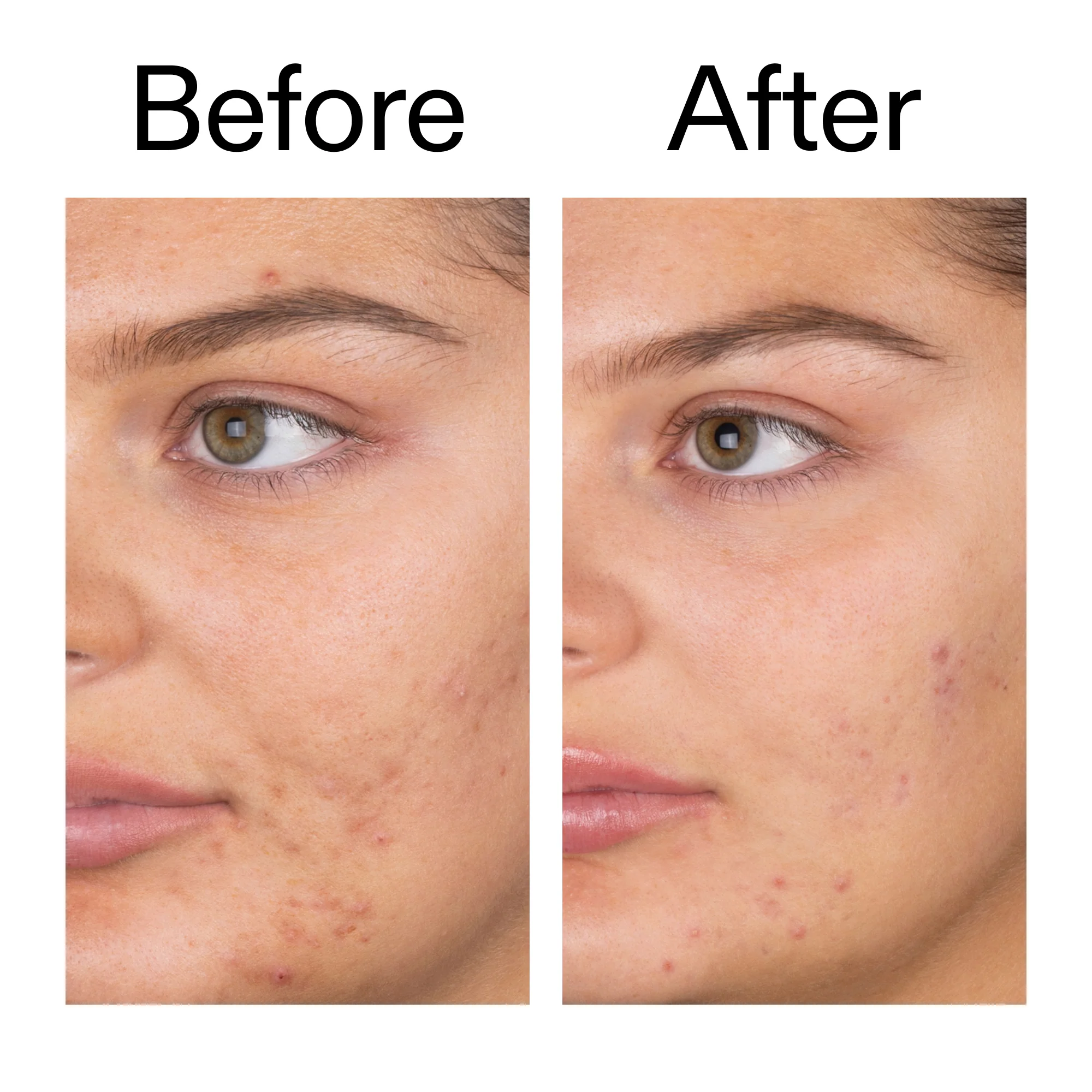 The Inkey List Salicylic Acid Cleanser  |150ml